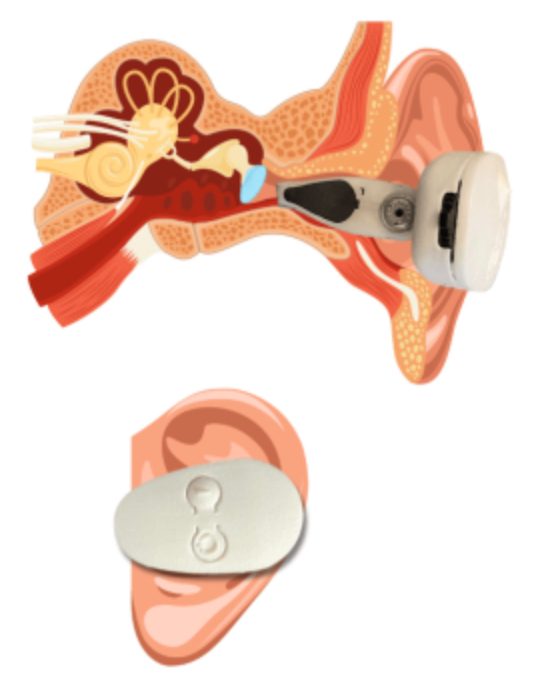 Cross-section of the ear showing EVANES resting in the ear canal against the auricular branch of the vagus nerve
